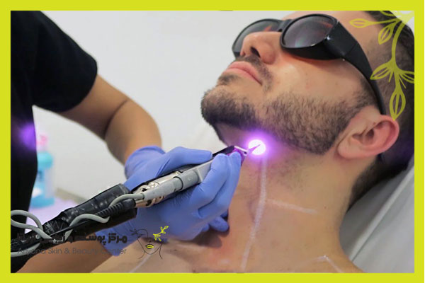 mens hair laser